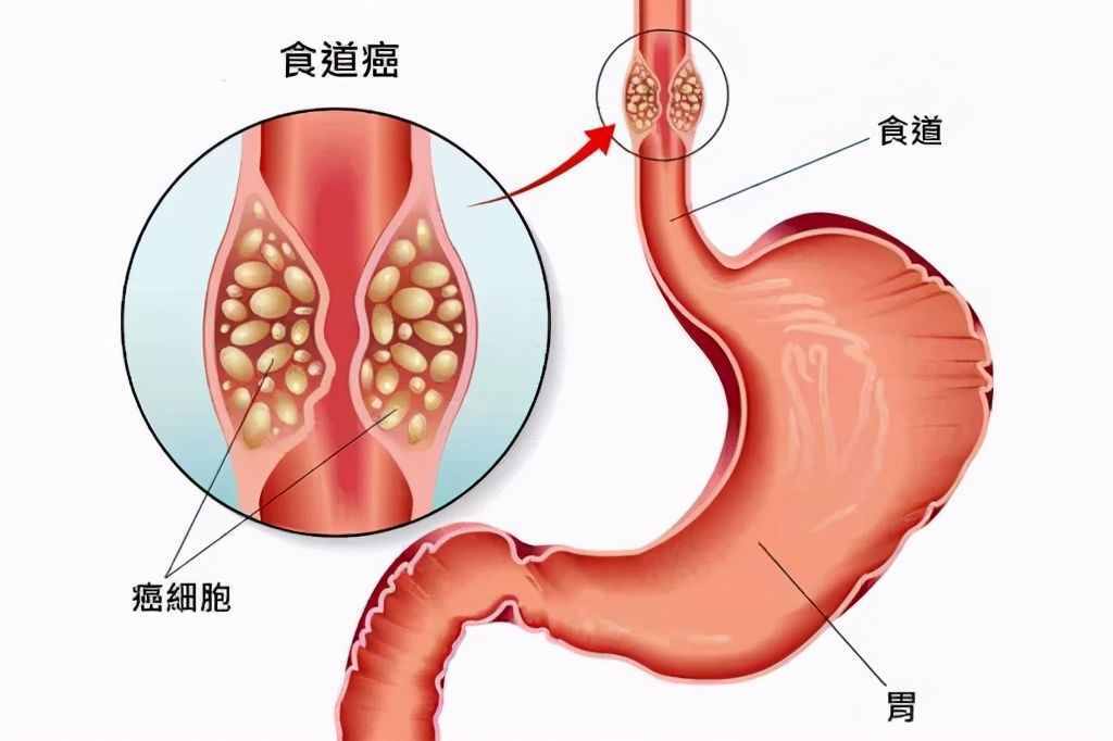 食道癌最新治疗方法概述